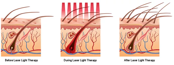 Laser hair regrowth technology