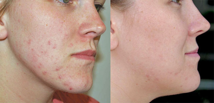 Results of getting rid of acne scars after 12 sessions of RLT
