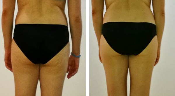 Results after cellulite laser treatment for 1 month