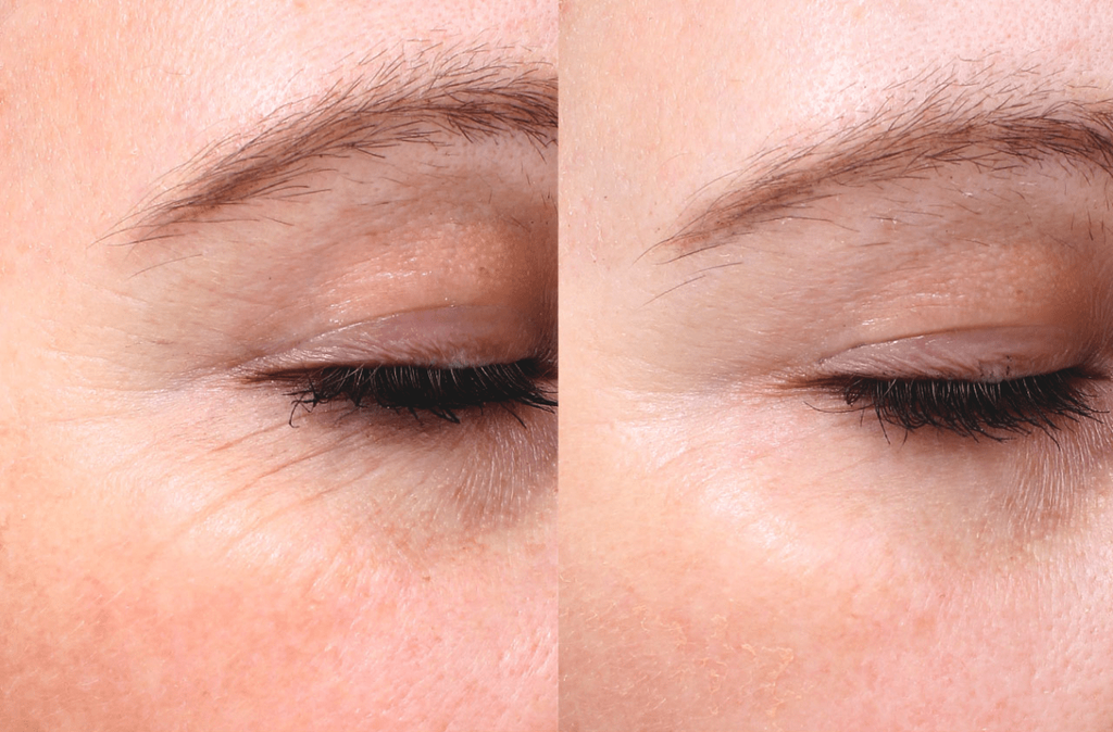 An example of wrinkle removal using the Neatcell Red Laser Pen
