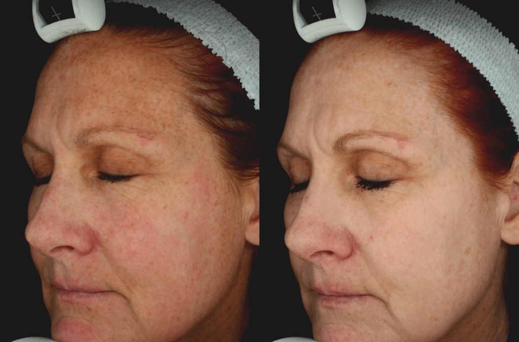 The example of age spot removal using the Neatcell Red Laser Pen