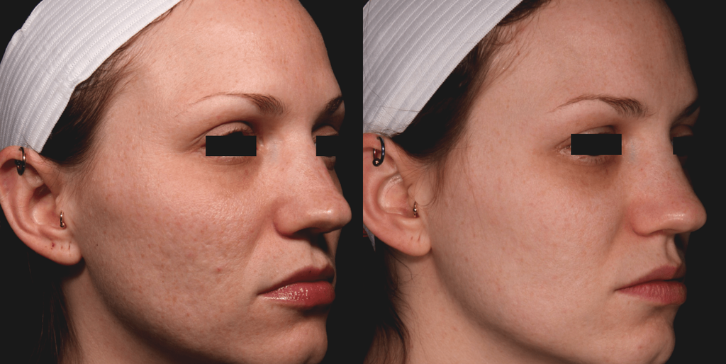 An example of acne scars removal using the Neatcell Red Laser Pen
