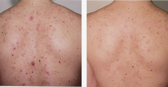 Before and after light therapy for back acne