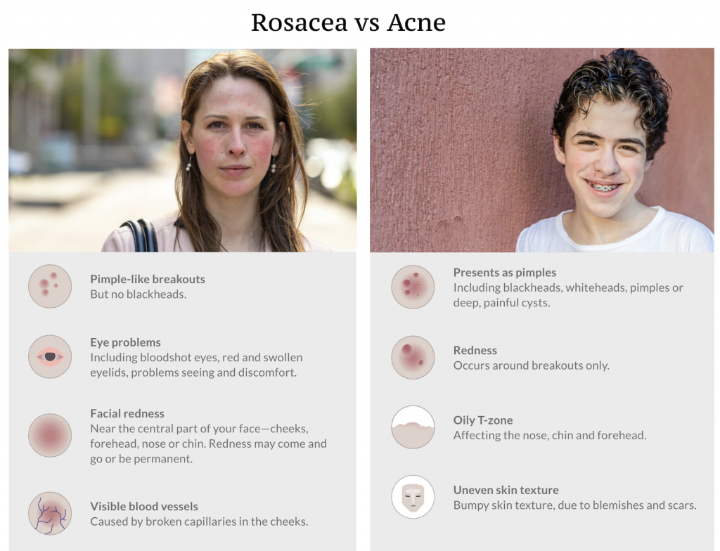 Difference between rosacea and acne