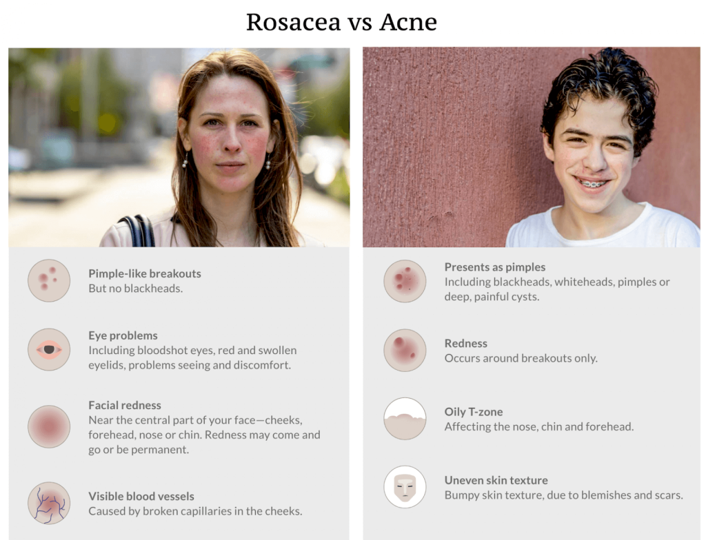 Difference between rosacea and acne