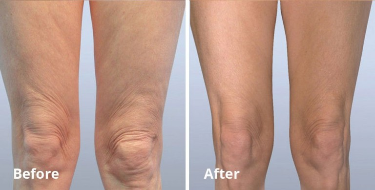 Skin tightening with non-invasive laser liposuction