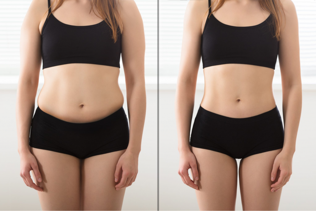 Does Laser Lipo Actually Work: Before and After Results