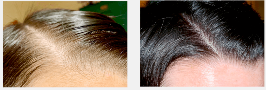 The result of using red light therapy devices for hair loss treatment 