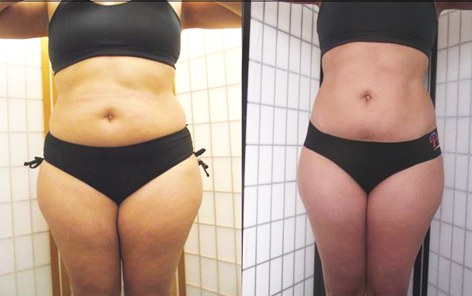 The result of using red light therapy devices for weight loss