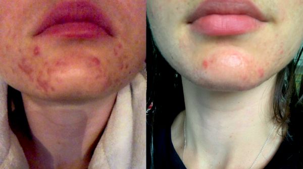 The result of using red light therapy devices for acne treatment 