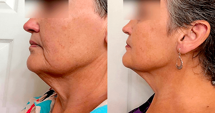The result of using red light therapy devices for anti-aging treatment 