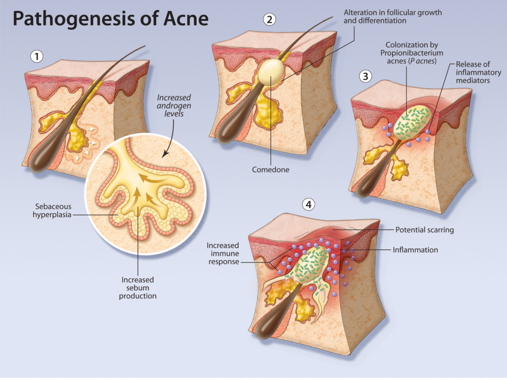 Pathogenesis of body acne