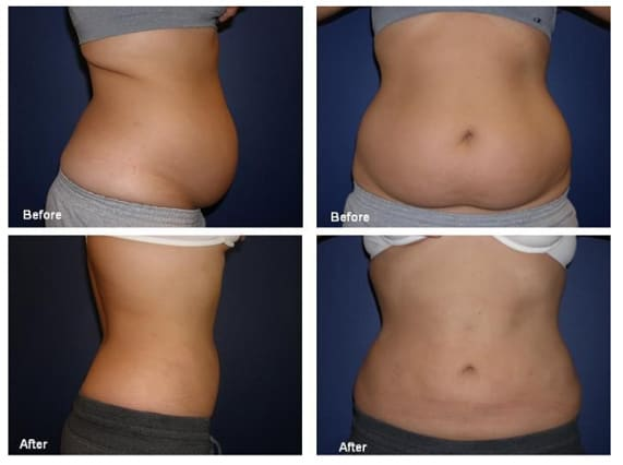 Belly fat reduction with non-invasive laser liposuction