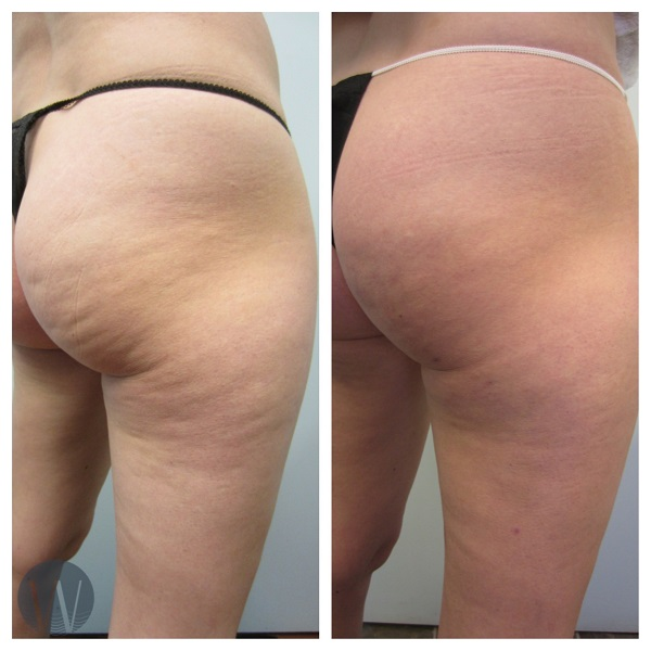 Cellulite reduction with non-invasive laser liposuction