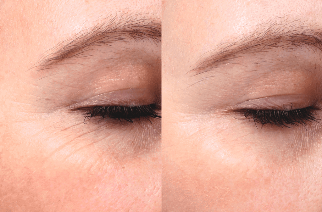 An example of wrinkle removal using the Neatcell Red Laser Pen