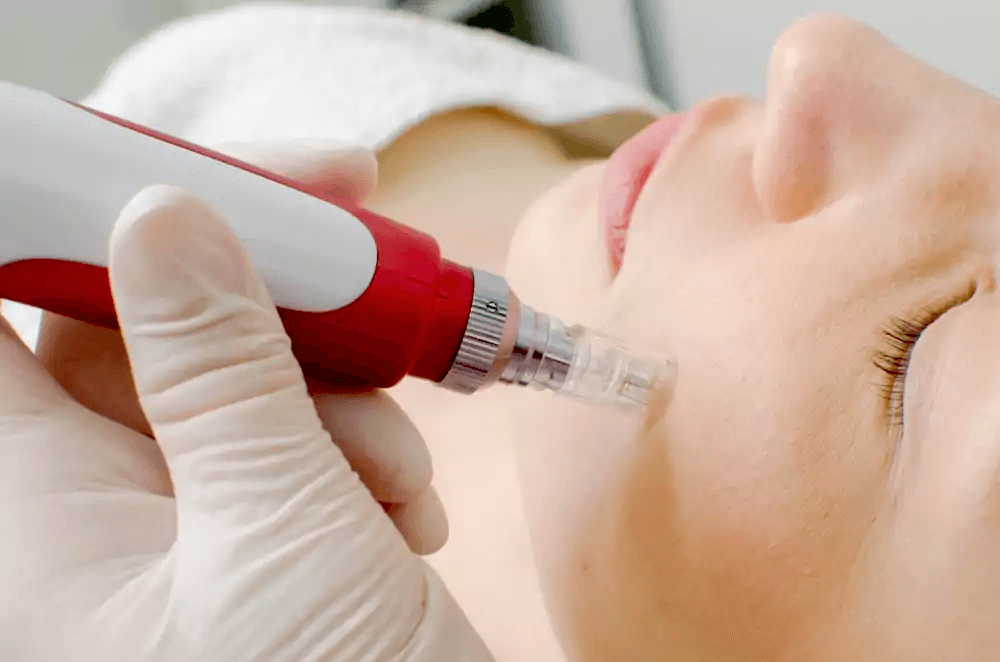 esthetician applies microneedling pen to the patient's cheek