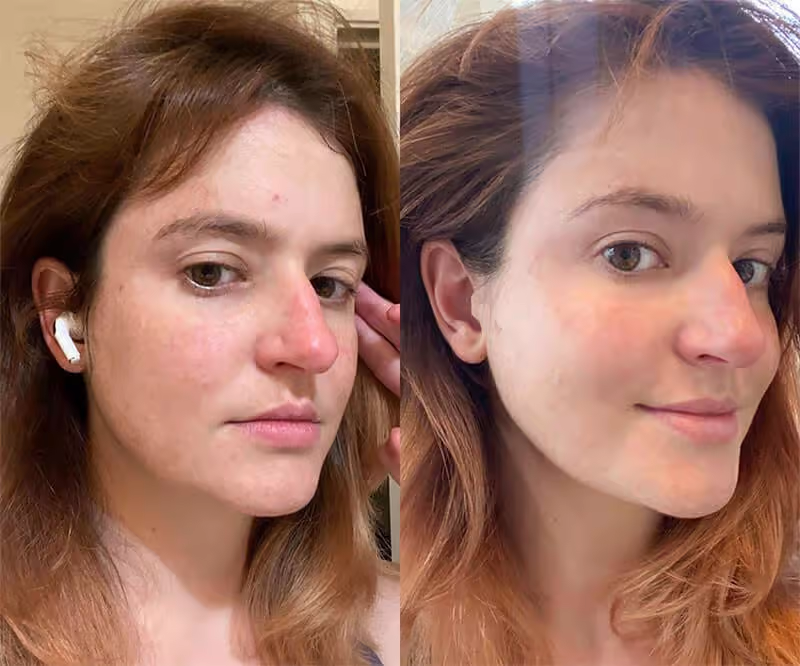 Before and After SolaWave Wand with Red Light Therapy (1 month)