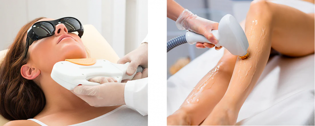Diode laser hair removal process