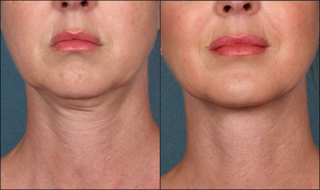 The result of using a laser to tighten the skin of the neck