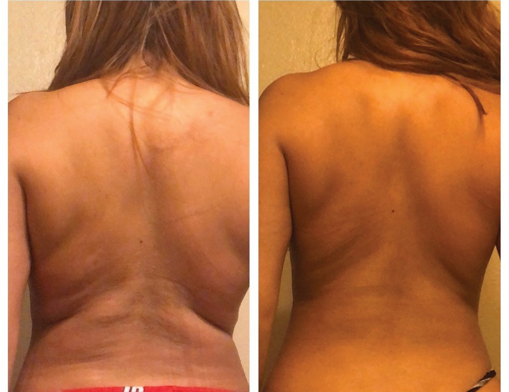 Before and after Cryo Toning for cellulite (4 sessions)