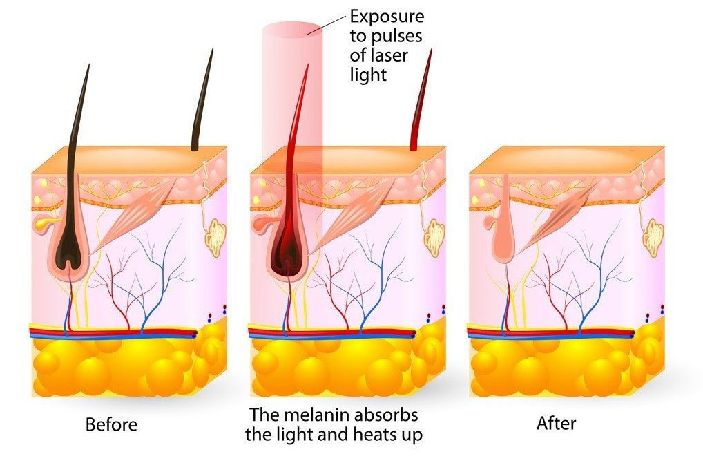 Working principle of diode laser hair removal