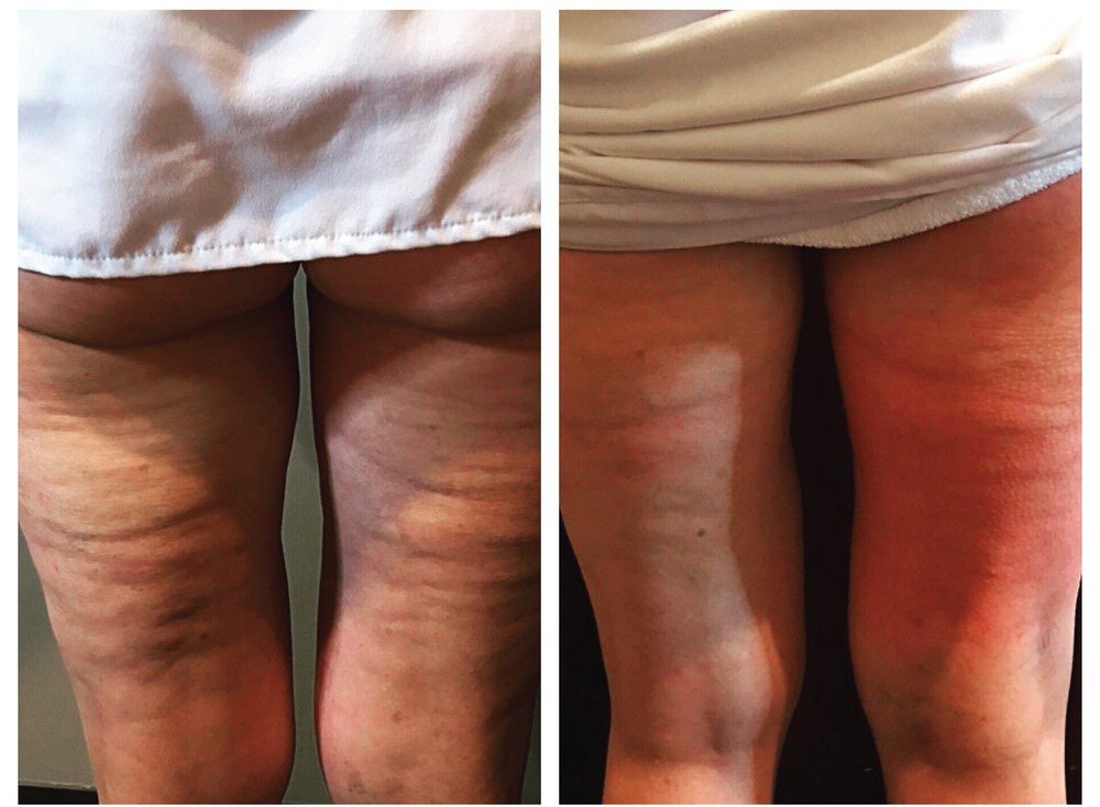 Before and after Cryo Toning for cellulite (5 sessions)