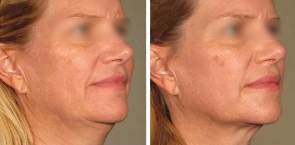The result of using a laser for facial skin tightening