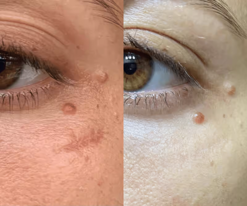 Before and After SolaWave Wand with Red Light Therapy (3 months)