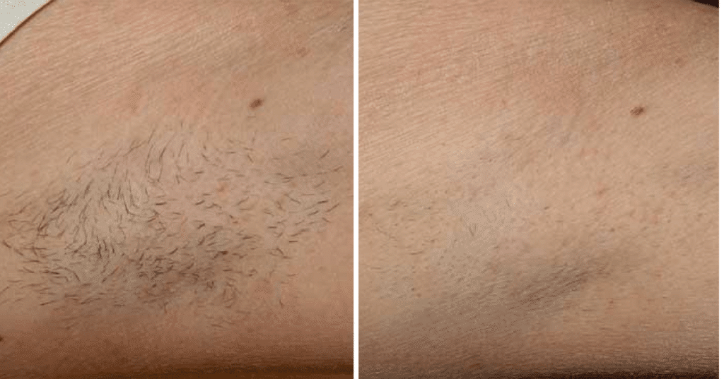 The result of using a laser diode hair removal device