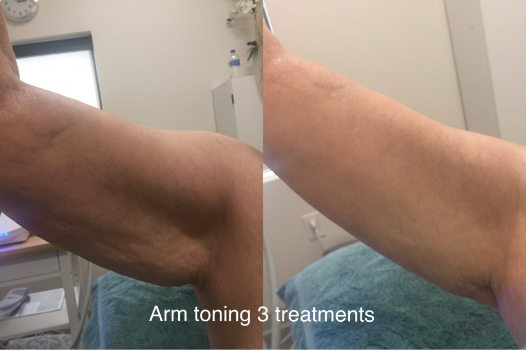 Before and after Cryo Toning on arms (3 sessions)