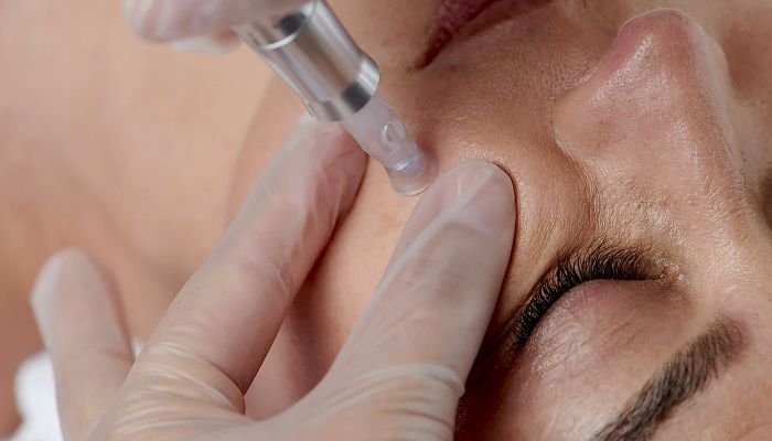 professional performs a microneedling procedure