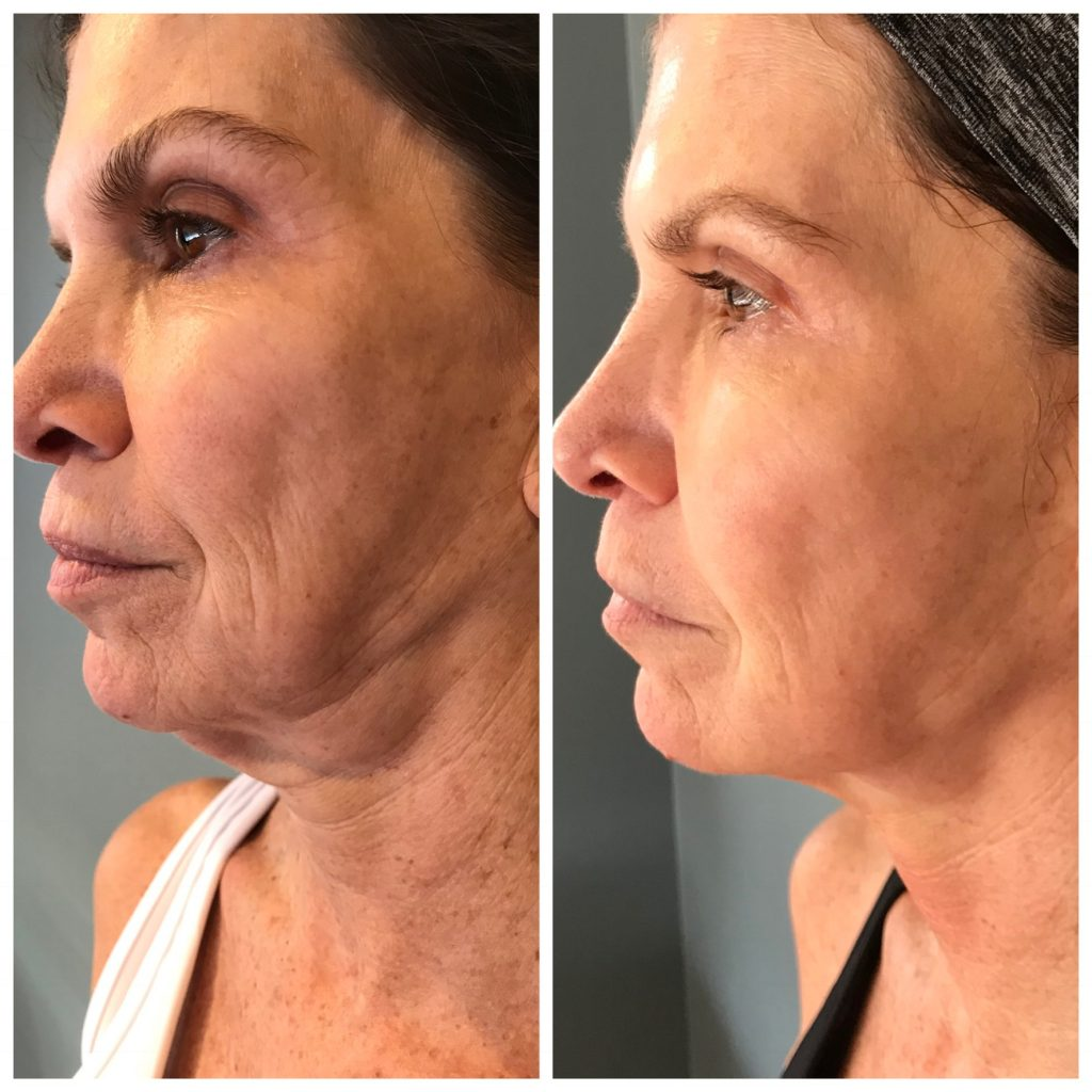 Before and after Cryo Toning for double chin (5 sessions)