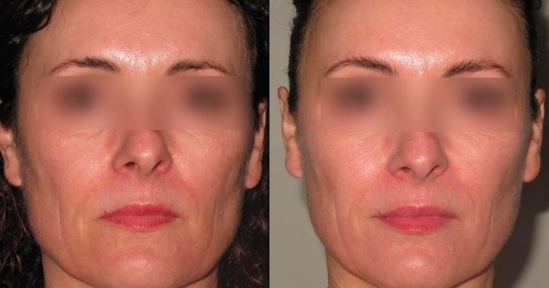 The result of using infrared light for the treatment of age-related changes