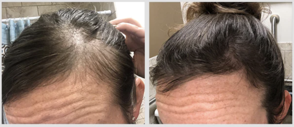 The result of using laser therapy (650 nm) for hair loss treatment