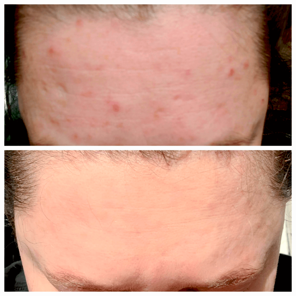 Before and after using the NuDerma 