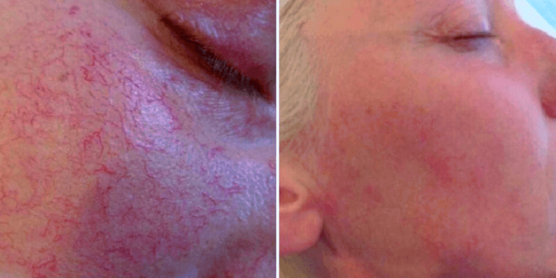 Result of light therapy treatment after 2 sessions