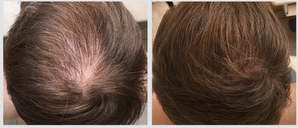 The result of using laser therapy (665 nm) for hair loss treatment