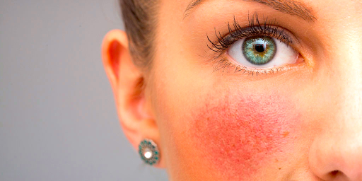 Laser treatment for rosacea