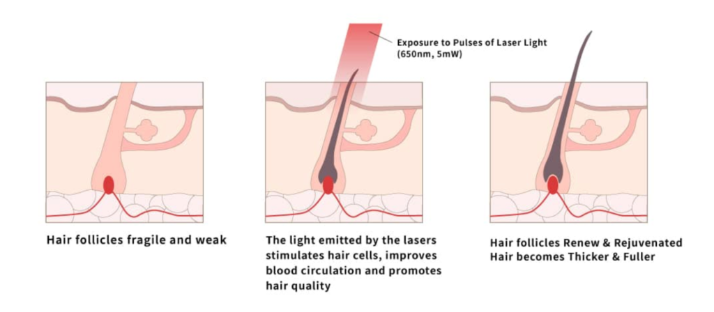 Effect of laser light on hair follicles
