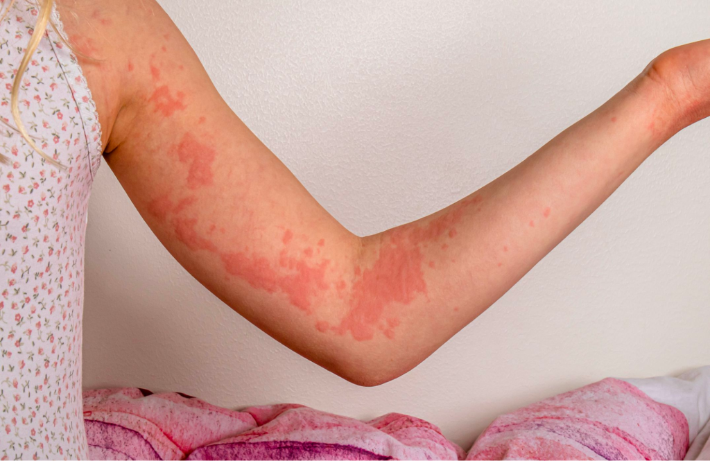 Hives on the arm