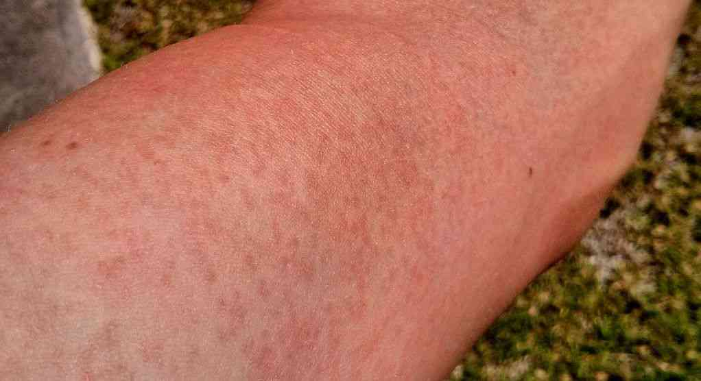 Dry skin rash
