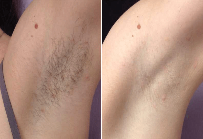 Before/After laser hair removal
