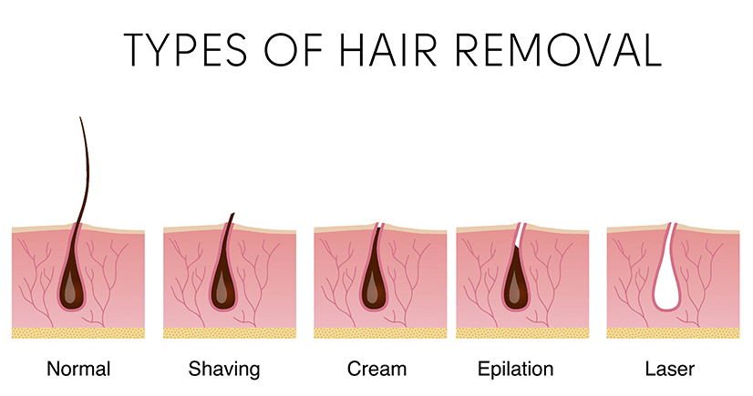Hair Removal Methods 