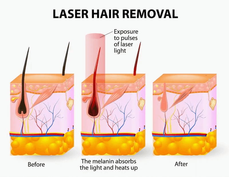 Stages of Laser Hair Removal