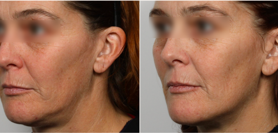 NuFACE anti-aging results NuFACE anti-aging results