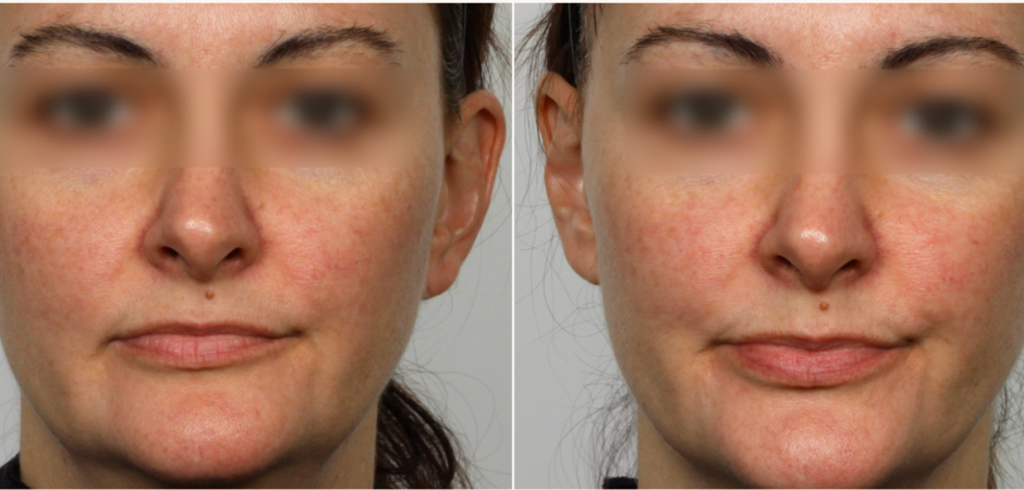 NuFACE anti-aging results NuFACE anti-aging results