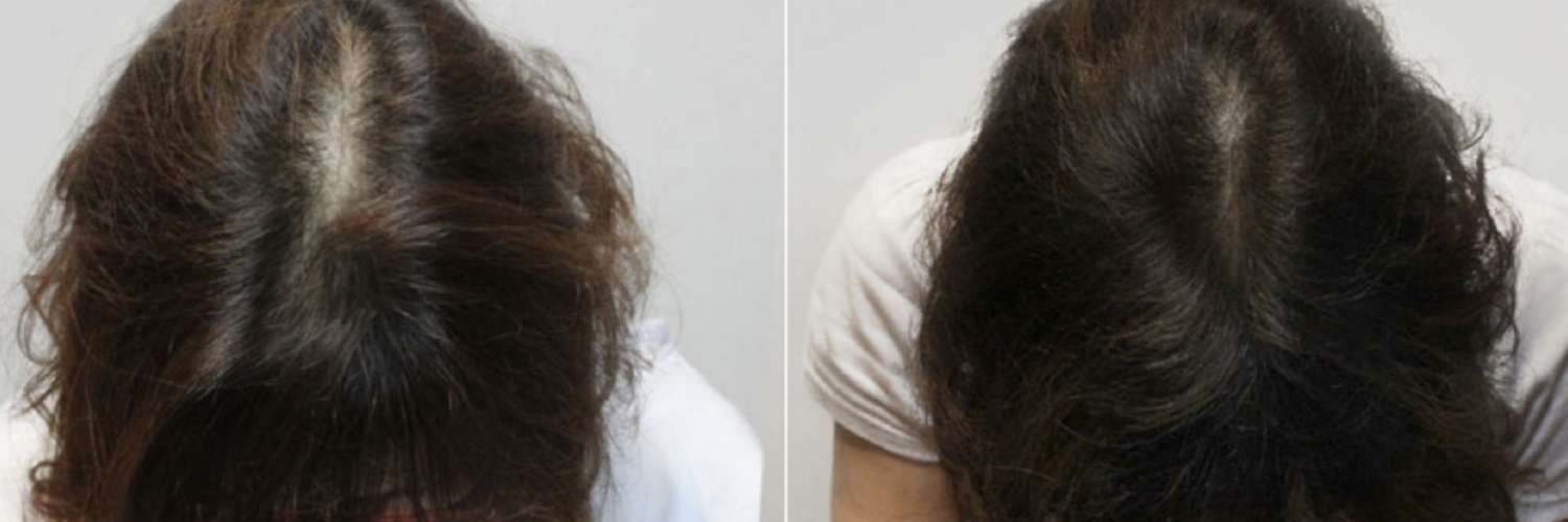 Results of laser cap for hair loss treatment Results of laser cap for hair loss treatment