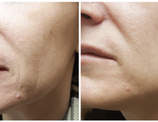Skin improvement result after using Ziip device Skin improvement result after using Ziip device