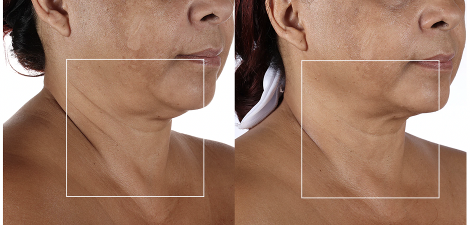 NuFACE anti-aging results NuFACE anti-aging results