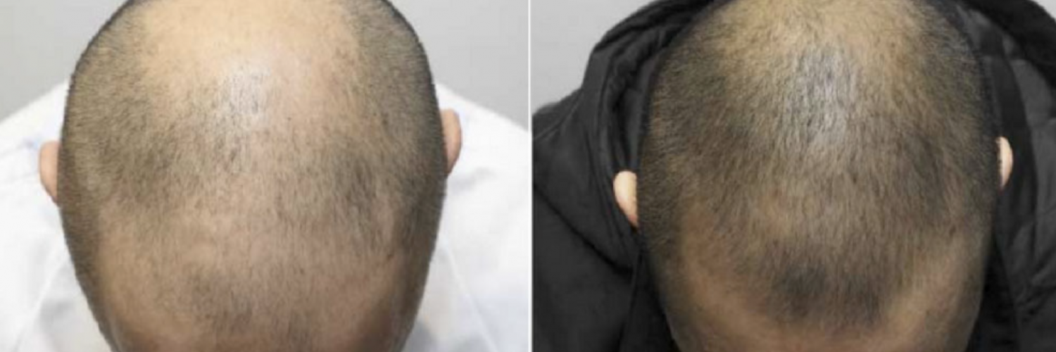 Results of laser cap for hair loss treatment Results of laser cap for hair loss treatment